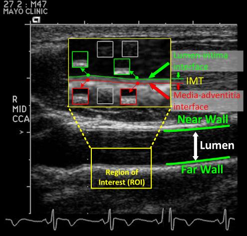 Intima Media Thickness